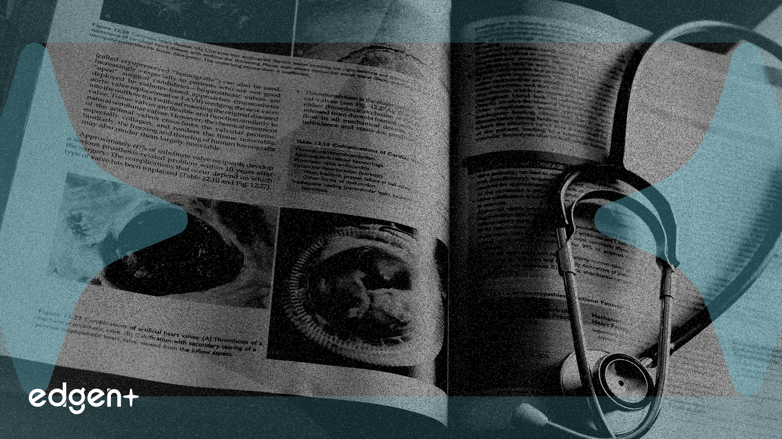 Le médicament contre le cancer du poumon d'AstraZeneca échoue en phase finale