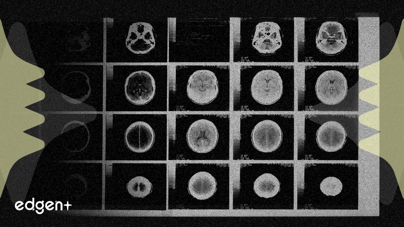 Thermo Fisher Launches Alzheimer’s Registry to Track Real-World Drug Data