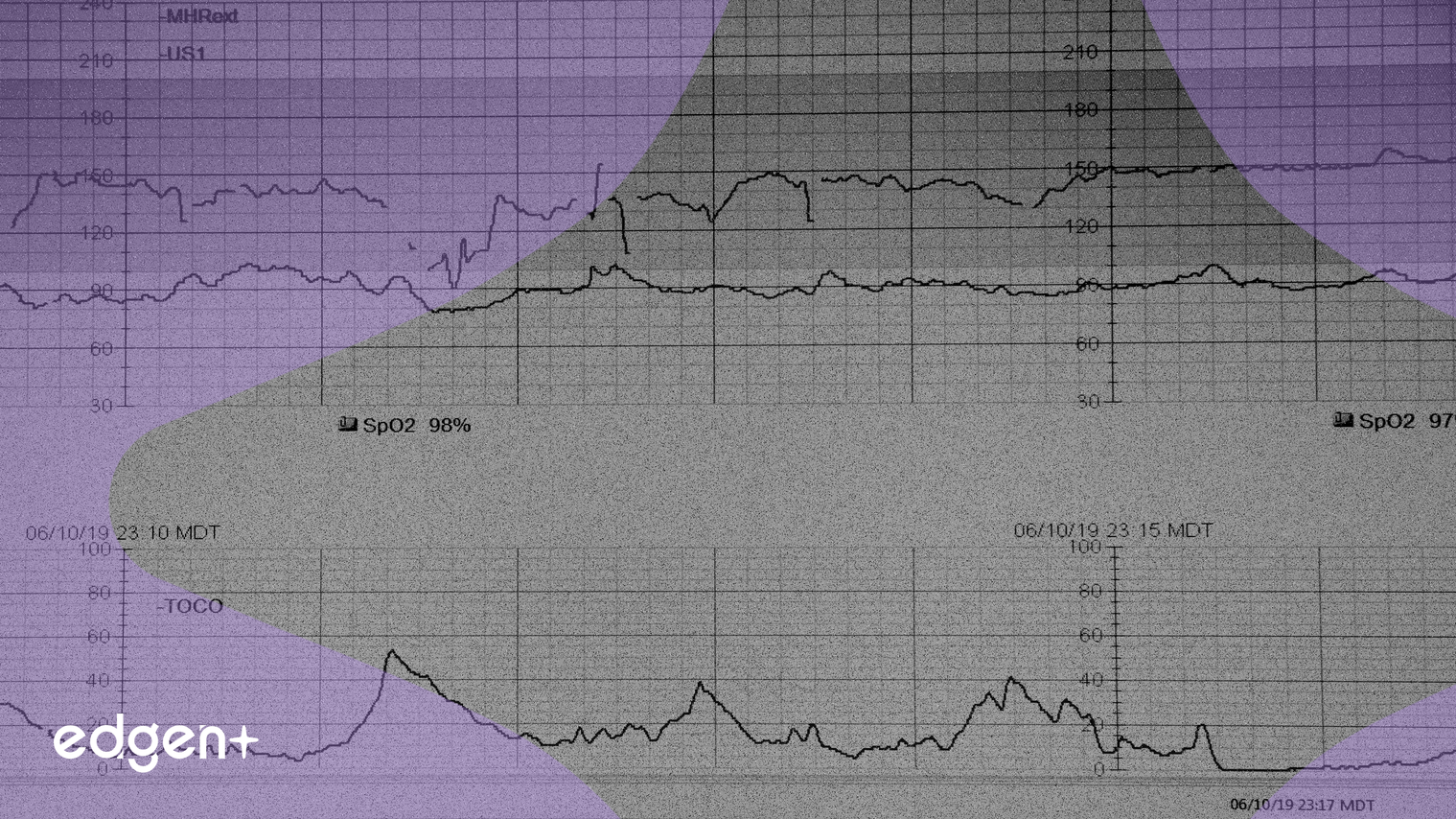 阿斯利康的 Baxdrostat III 期試驗顯示血壓顯著降低