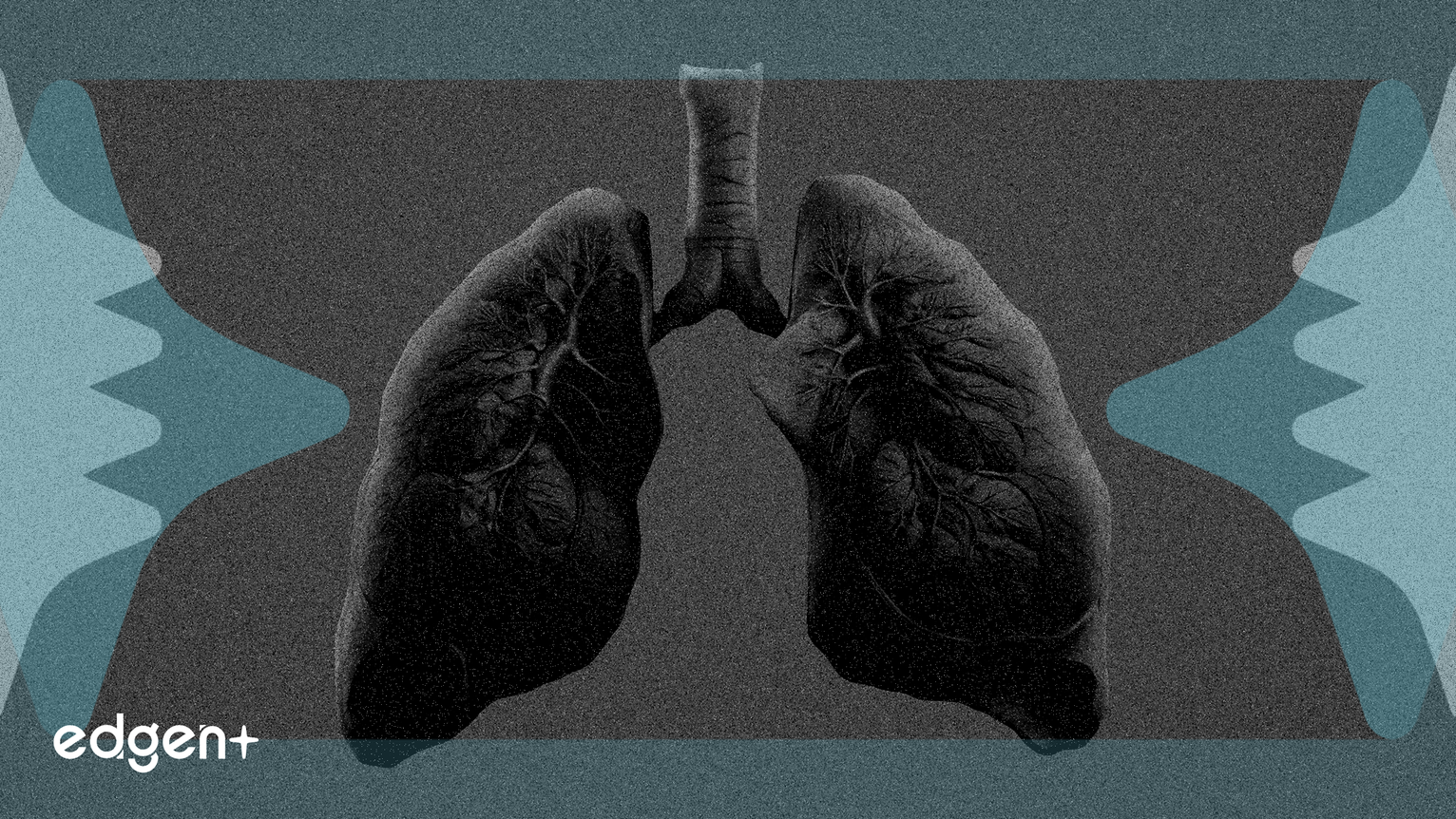 L'action Insmed chute de 20% après l'échec de son médicament pour les sinus en essai de phase IIb