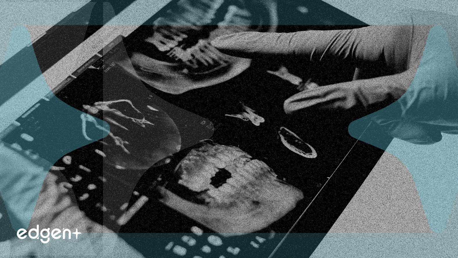 AngioDynamics Gains 30% as Med Tech Sales Grow 26%