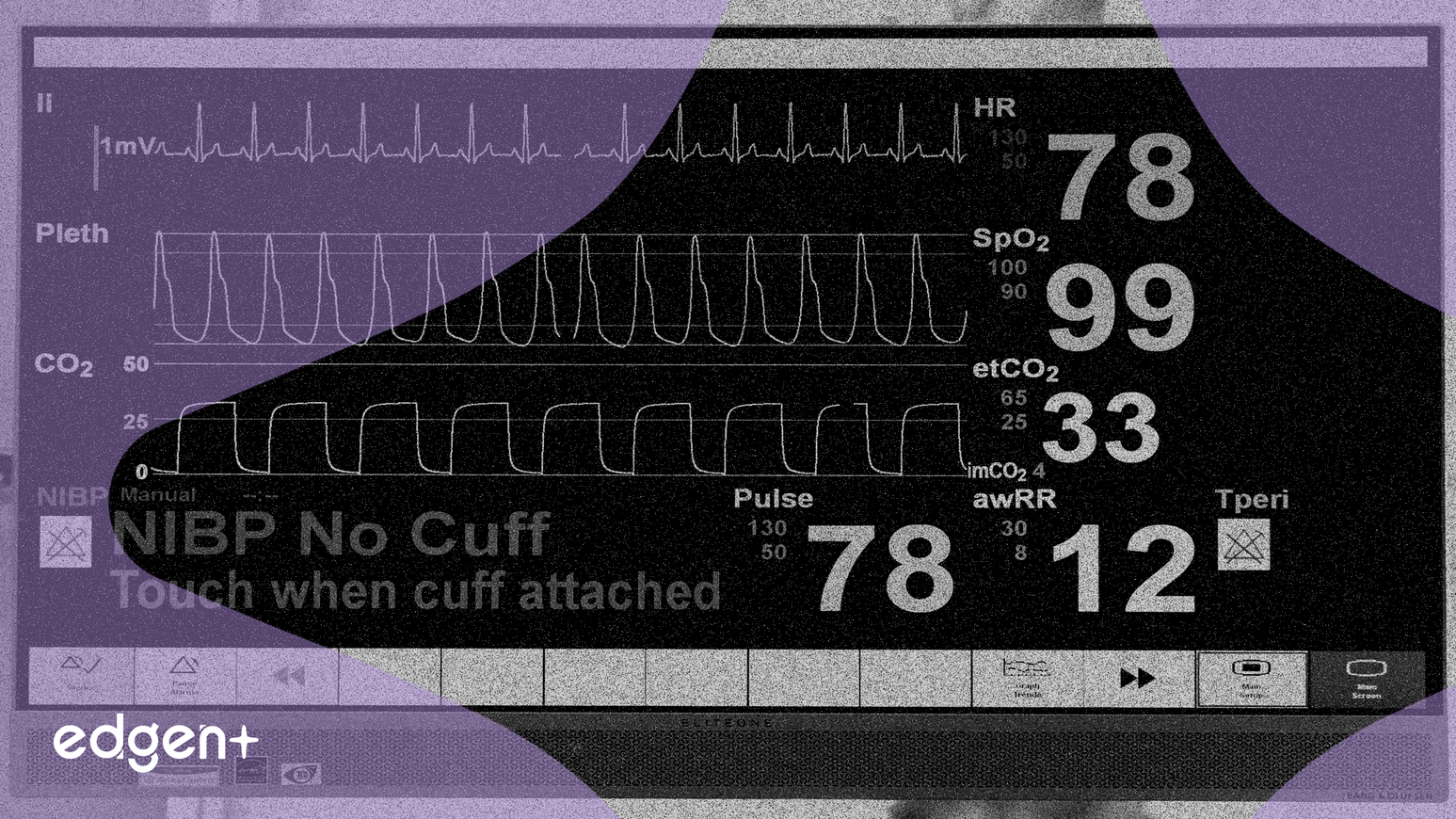 AtriCure Advances Ablation With Dual-Energy Platform