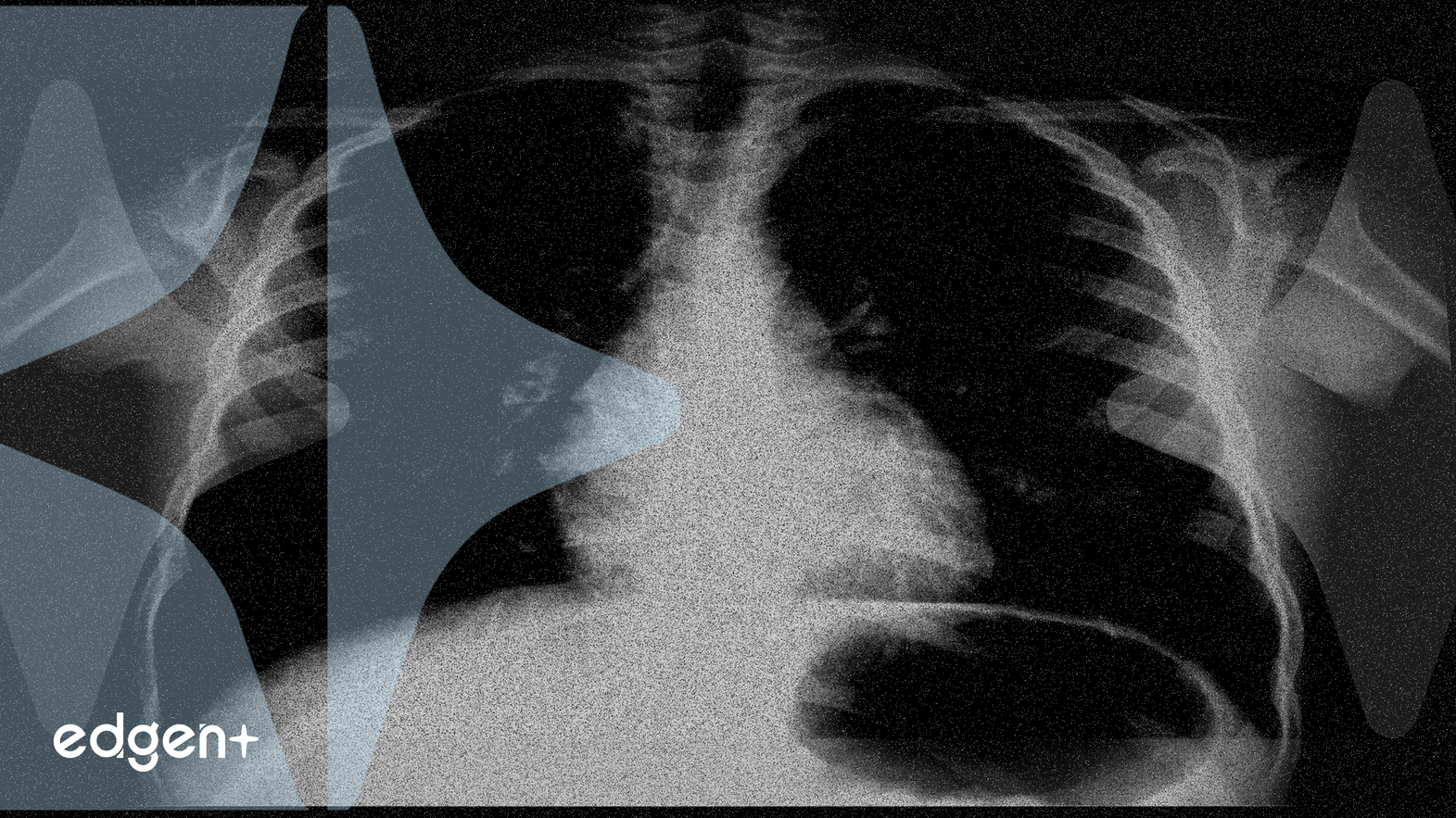 Insmed加入那斯達克100指數，引發機構需求